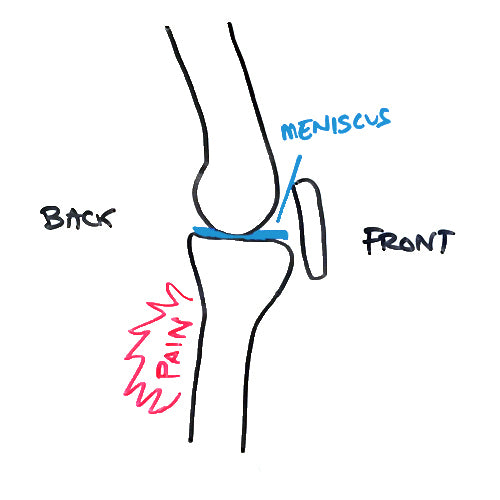 PAIN BEHIND KNEE: THE ‘OL WALLET-IN-DOOR SYNDROME