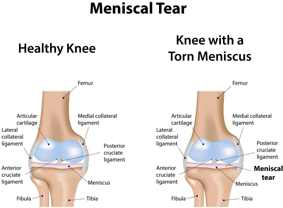 What knee brace is best for torn meniscus?