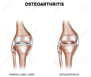 Which knee support is best for arthritis?