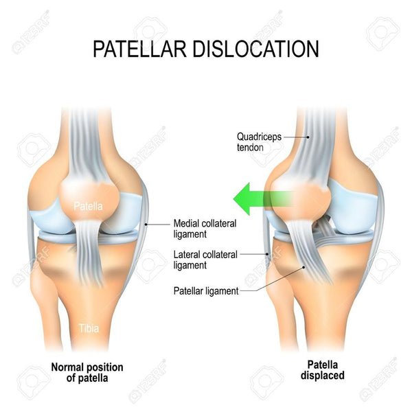 What is the best knee brace for patellar tendonitis?