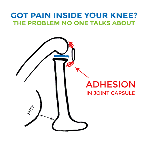 PAIN ON INSIDE OF KNEE? THE PROBLEM NO ONE IS TALKING ABOUT